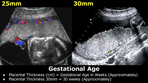 how to measure placental thickness|placental abnormalities seen on ultrasound.